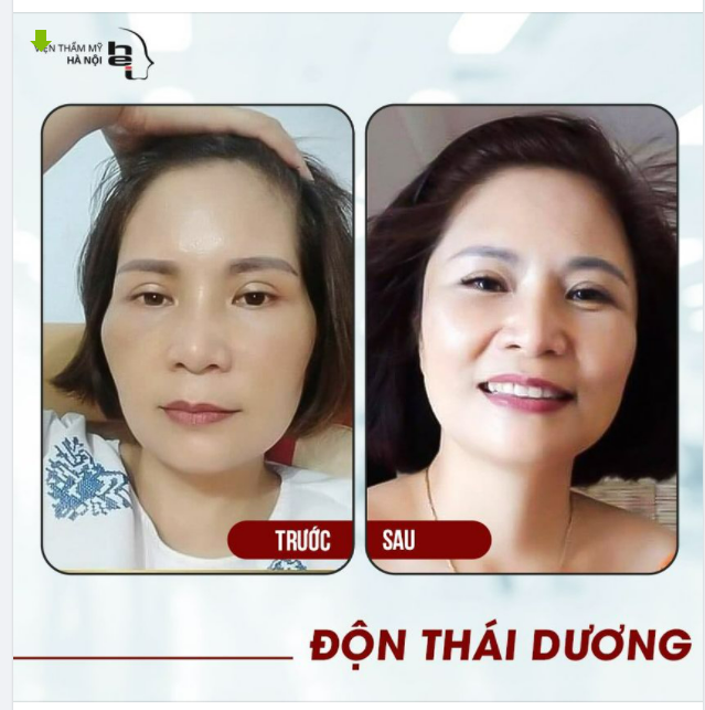 "Thái dương hốc hác, ốm yếu và thiếu sức sống? Phần thái dương lõm khiến bạn nhìn như già đi cả chục tuổi?