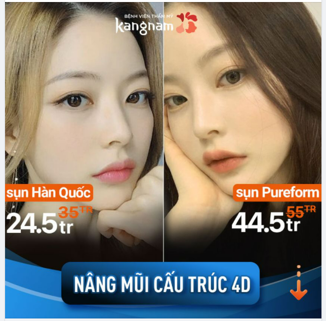 Tháng 7 này, NÂNG MŨI CẤU TRÚC 4D có ưu đãi gì?