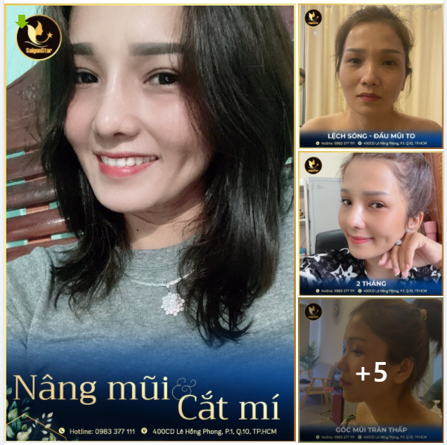 THĂNG HẠNG NHAN SẮC SAU NÂNG MŨI - CẮT MÍ