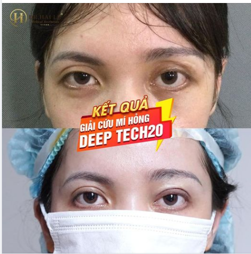 THANH XUÂN " ĐẸP LẠI" CHỈ SAU KHI SỬA MÍ DEEP TECH20