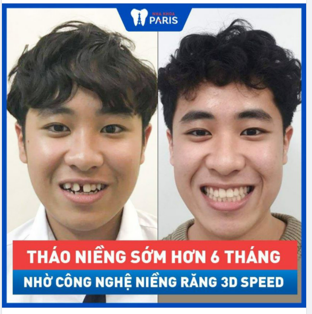 THÁO NIỀNG SỚM 6 THÁNG NHỜ CÔNG NGHỆ NIỀNG RĂNG 3D SPEED