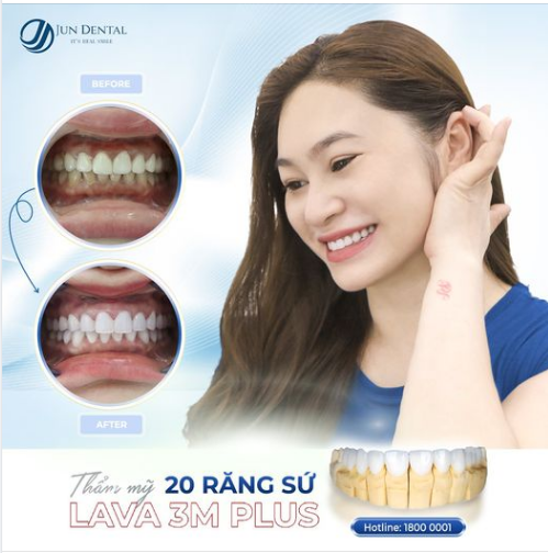 THAY ÁO MỚI RĂNG SỨ CŨ TỐI MÀU -  RĂNG SỨ LAVA 3M PLUS