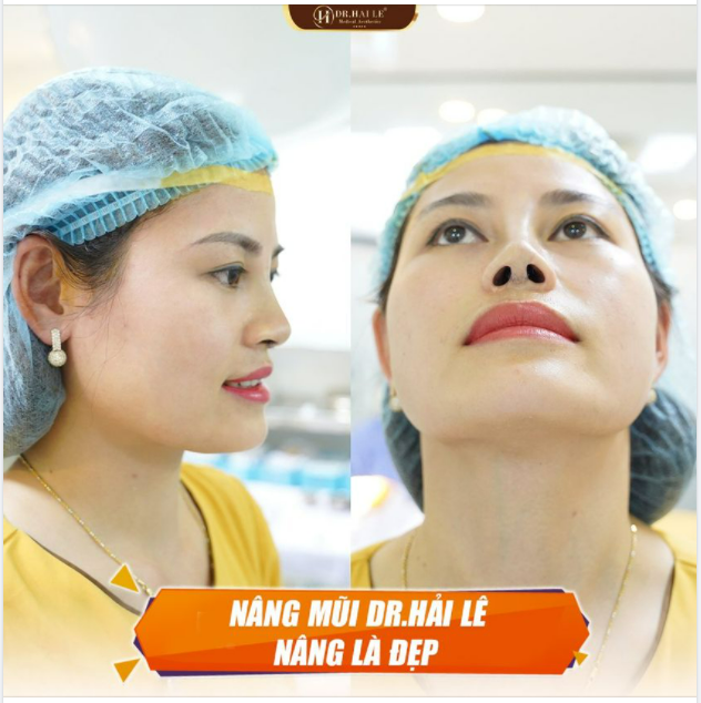 Thay dáng mũi - Đổi vận may!!