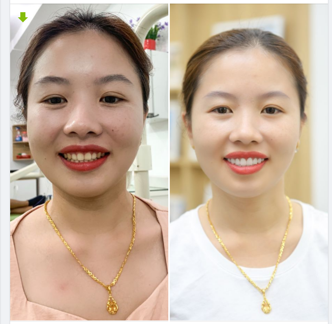 THAY ĐỔI 180 ĐỘ SAU KHI DÁN 22 VENEER SỨ CAO CẤP, CHÍNH HÃNG
