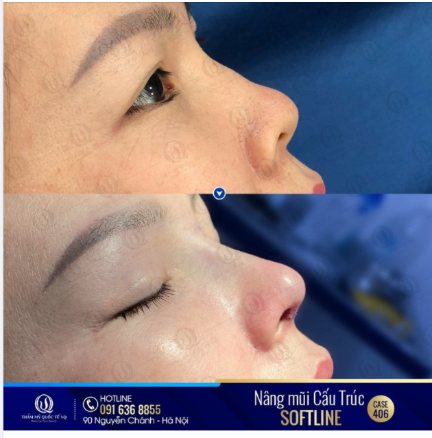 Thay đổi dáng mũi tài lộc thăng hoa