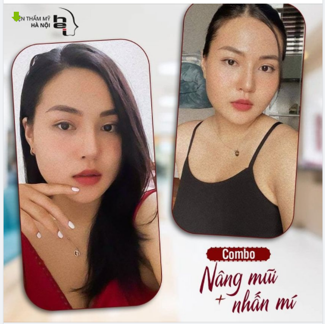 Thay đổi diện mạo với Combo Nhấn mí + Nâng mũi.