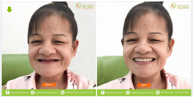 Thay đổi hoàn toàn diện mạo với một nụ cười mới.