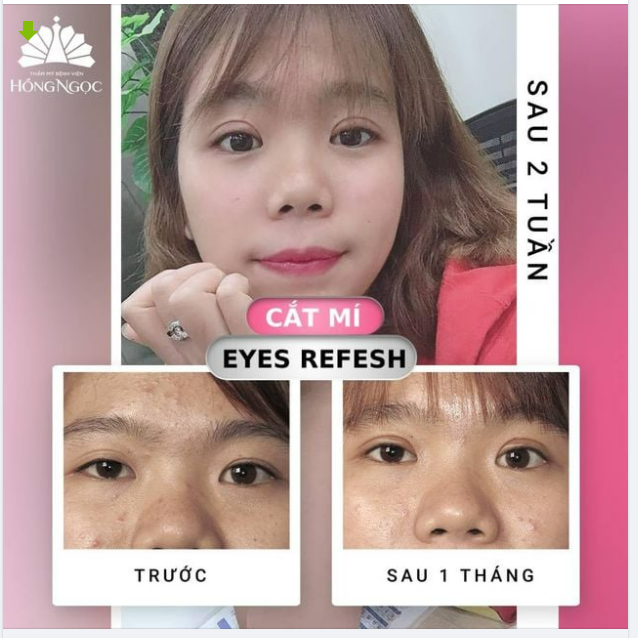 THAY ĐỔI MÍ MẮT - HOÀN THIỆN NHAN SẮC
