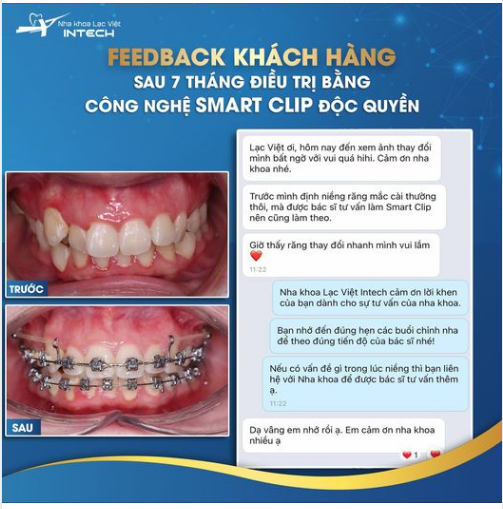 THAY ĐỔI NGOẠN MỤC CHỈ SAU 7 THÁNG VỚI CÔNG NGHỆ SMART CLIP ĐỘC QUYỀN