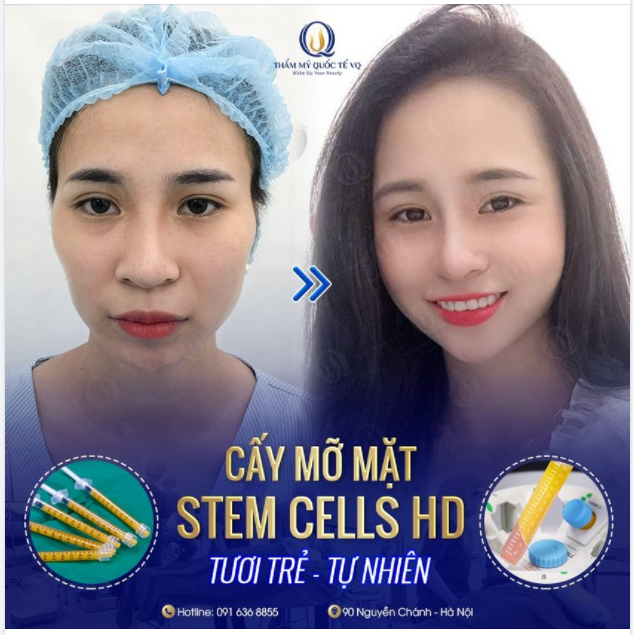 Thay đổi nhan sắc ngoạn mục chỉ với một tuyệt chiêu nhỏ của bác sĩ Vũ Quang Cấy mỡ tự thân Stem Cells HD
