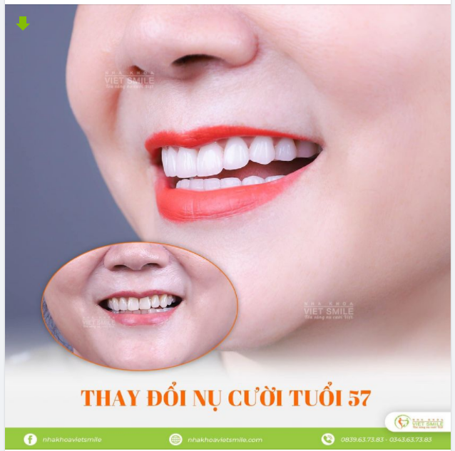 THAY ĐỔI NỤ CƯỜI MỚI Ở TUỔI 57 VỚI PHƯƠNG PHÁP RĂNG BỌC SỨ