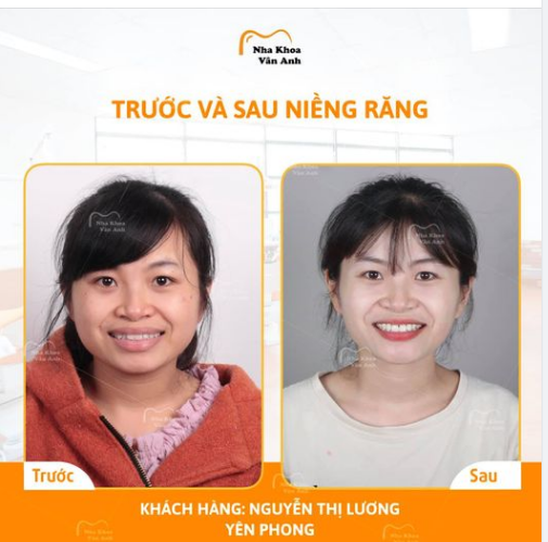 THAY ĐỔI NỤ CƯỜI - TỰ TIN GIAO TIẾP SAU KHI THÁO NIỀNG RĂNG