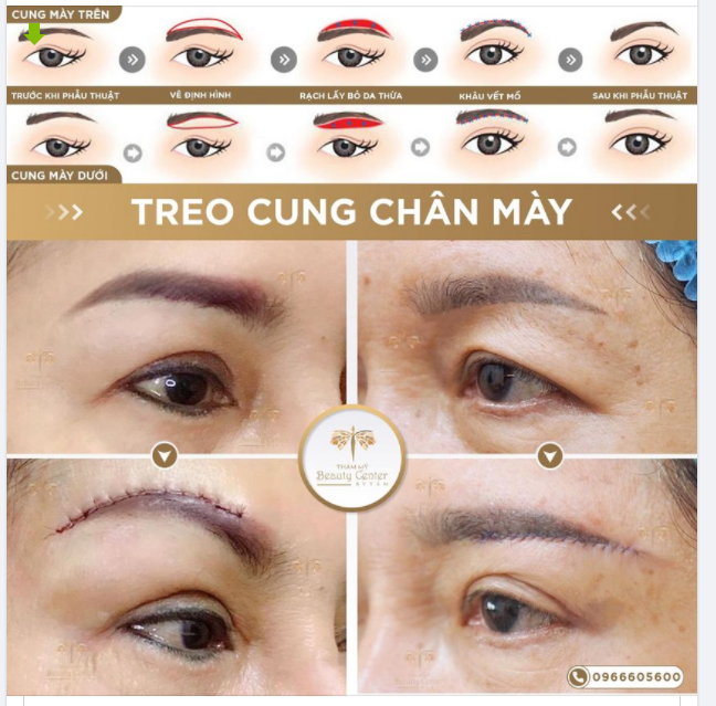 Thế nào là nâng cung mày , treo cung chân mày