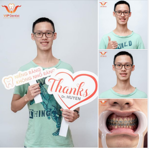 THÊM 1 KHÁCH HÀNG ĐÓN NHẬN NIỀM VUI HOÀN THIỆN NỤ CƯỜI TRƯỚC KHI GIÃN CÁCH