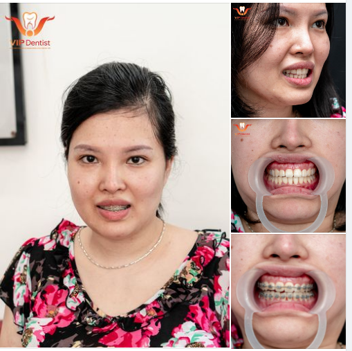 THÊM MỘT KHÁCH HÀNG MỚI KHỞI ĐẦU HÀNH TRÌNH CHỈNH NHA TẠI VIP DENTIST