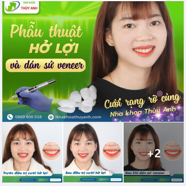 THOẢI MÁI SELFIE VỚI COMBO ĐIỀU TRỊ CƯỜI HỞ LỢI + DÁN SỨ VENEER