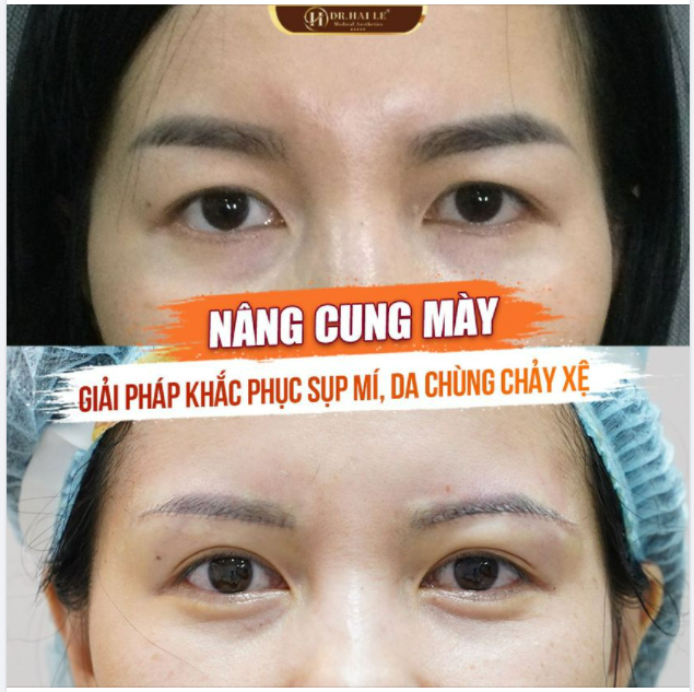 Thời gian, tuổi tác vốn là "kẻ thù" của phái đẹp Sụp mí, da chùng chảy xệ...