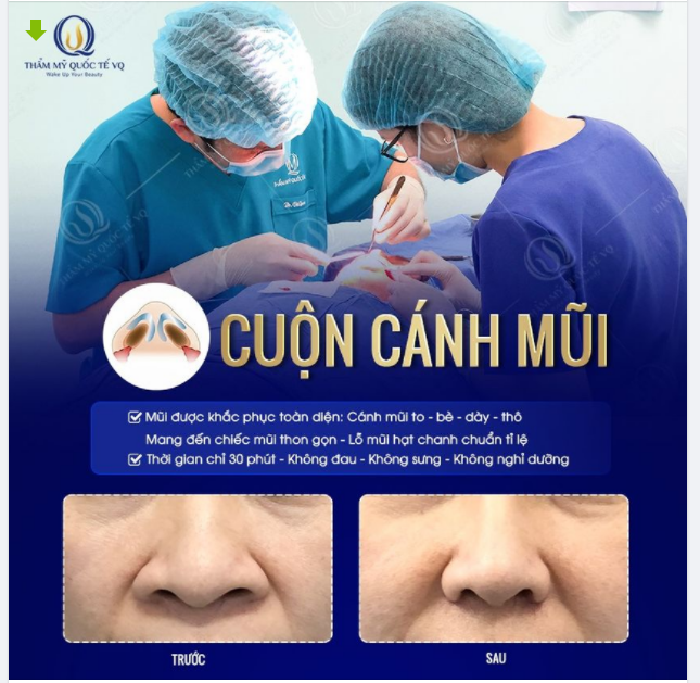 Thu gọn cánh mũi giải pháp cho gương mặt hài hòa