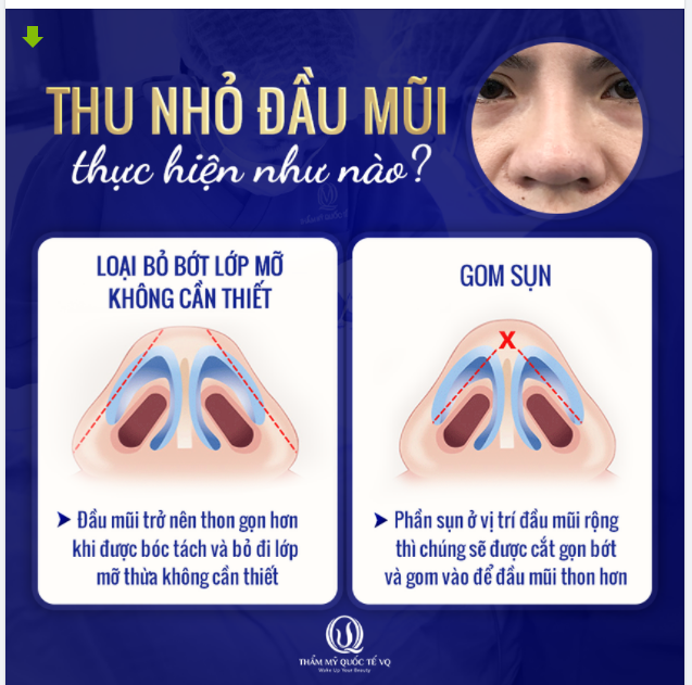 THU NHỎ ĐẦU MŨI ĐƯỢC THỰC HIỆN NHƯ THẾ NÀO ??