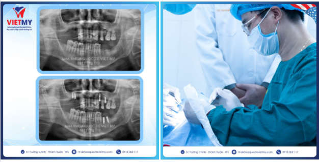 Tiếp tục là Case trồng răng Implant cho cô Nhung đến từ Long Biên- Hà Nội