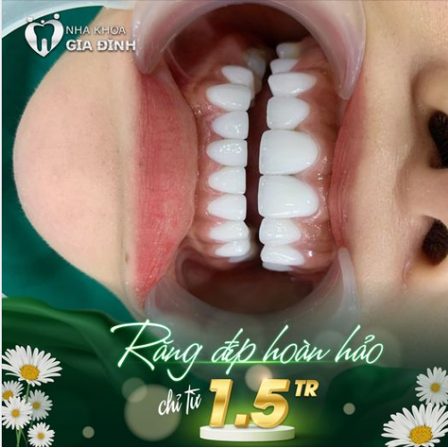 TIẾP TỤC LÀ MỘT TUYỆT PHẨM RĂNG SỨ VỪA THỰC HIỆN XONG TẠI NHA KHOA GIA ĐÌNH