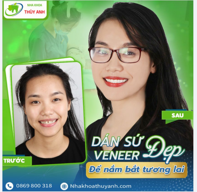 TIÊU CHUẨN ĐÁNH GIÁ MẶT DÁN SỨ CHẤT LƯỢNG