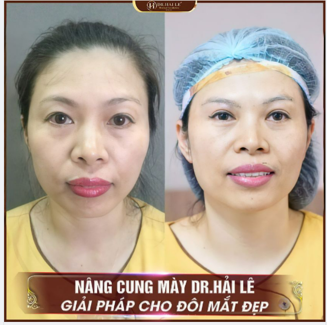 Tiểu phẫu Nâng cung mày tại Dr.Hải Lê - Giải pháp vàng cho đôi mắt tươi trẻ.!