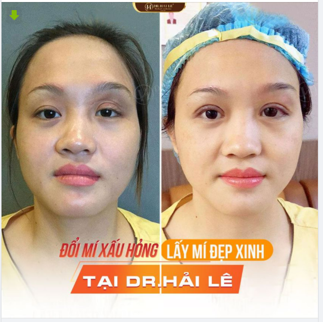 Tin vui cho các bạn đây! Mí xấu hỏng đến đâu cũng đẹp xinh trở lại chỉ sau 45phút sửa mí Deep Tech20 tại Dr.Hải Lê