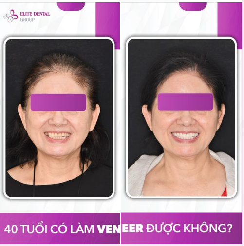 TÔI NĂM NAY NGOÀI 40 TUỔI THÌ CÓ ĐIỀU TRỊ DÁN VENEER SỨ ĐƯỢC KHÔNG?