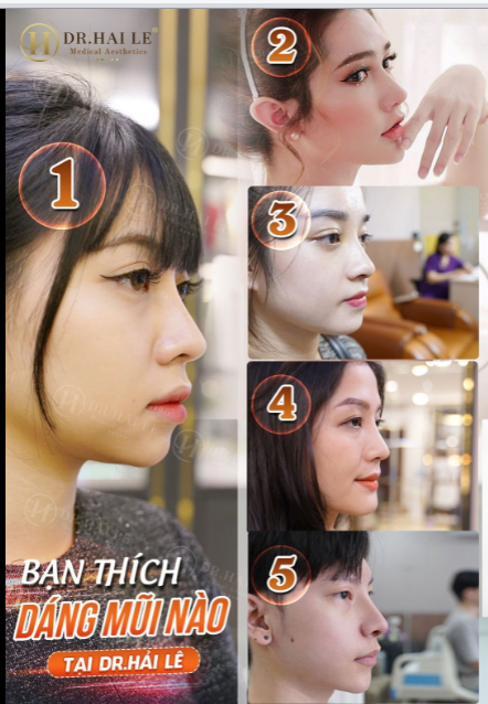 Tổng hợp 5 "góc nghiêng" thần thánh sau khi Nâng mũi tại Dr.Hải Lê