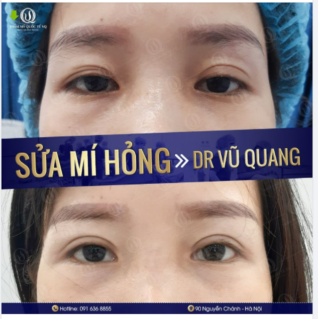 TRẢI LÒNG CỦA CÔ GÁI TỪNG CẮT MÍ BỊ HỎNG TẠI CƠ SỞ KÉM UY TÍN.
