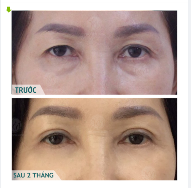 TRẺ HƠN 5 TUỔI SAU CẮT MÍ MẮT