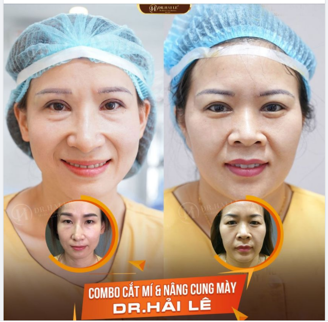 Trẻ hơn, đẹp hơn với Combo Cắt mí Nâng cung mày tại Dr.Hải Lê.!!