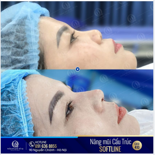 Trẻ mãi không già với dáng mũi Softline độc quyền của bác sĩ Vũ Quang