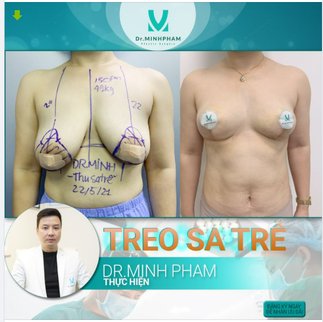 TREO SA TRỄ - CỨU TINH CHO V1 CHẢY SỆ