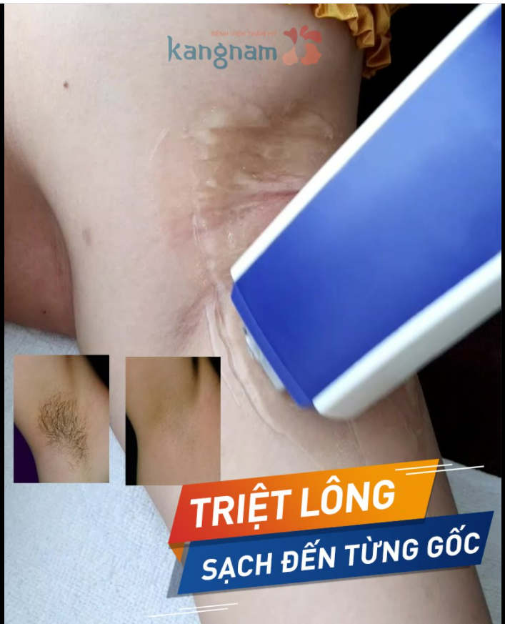 TRIỆT LÔNG DIODE LASER - sạch đến tận gốc