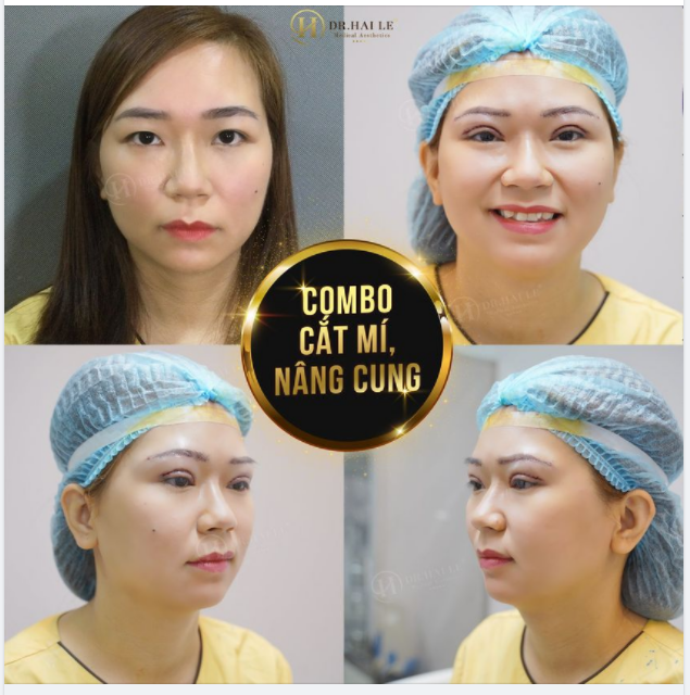 TRỢ GIÁ MÙA COVID LÀM ĐẸP TRẺ HÓA MẮT TOÀN DIỆN