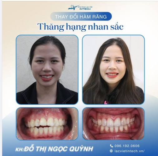 TRỞ THÀNH HOTGIRL SAU 22 THÁNG NIỀNG RĂNG TẠI NHA KHOA LẠC VIỆT INTECH