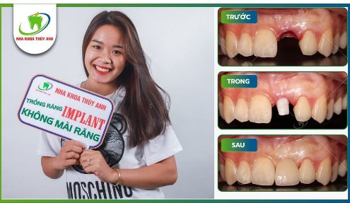 TRỒNG IMPLANT CHẮC CHẮN ĂN NHAI - HOÀN THẢO THẨM MỸ