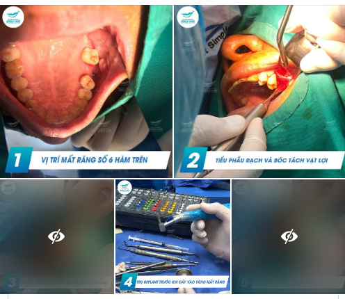 TRỒNG IMPLANT - THOẢI MÁI ĂN NHAI - TỰ TIN GIAO TIẾP