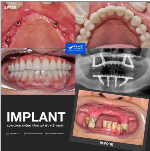 Trồng Implant toàn hàm  ALL- ON-4 IMPLANT cho khách hàng lớn tuổi, hoàn thành sau 12 ngày