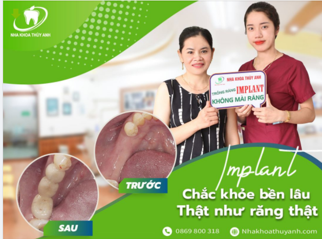 TRỒNG LẠI RĂNG MẤT BẰNG IMPLANT BẠN LO NGẠI ĐIỀU GÌ?