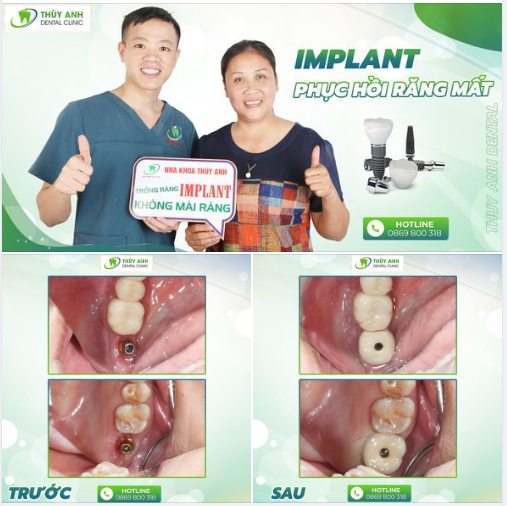 TRỒNG LẠI RĂNG MẤT QUAN TRỌNG NHƯ THẾ NÀO