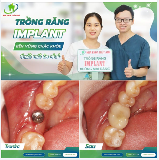 TRỒNG RĂNG 1 LẦN, ĂN NHAI TRỌN ĐỜI
