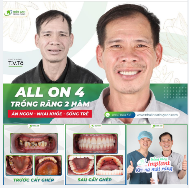 TRỒNG RĂNG ALL ON 4 2 HÀM ĂN NGON - NHAI KHỎE - SỐNG TRẺ