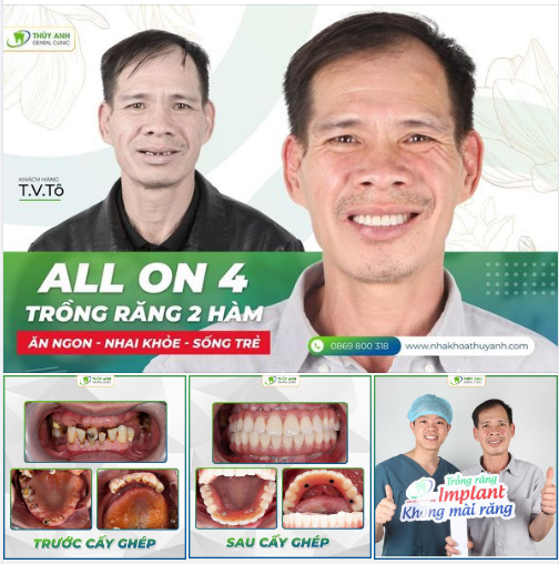 TRỒNG RĂNG ALL ON 4 2 HÀM ĂN NGON - NHAI KHỎE - SỐNG TRẺ