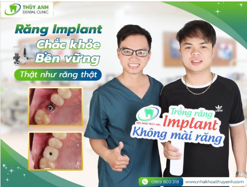 TRỒNG RĂNG CÔNG NGHỆ FLAPLESS KHÔNG SƯNG ĐAU, KHÔNG CHẢY MÁU