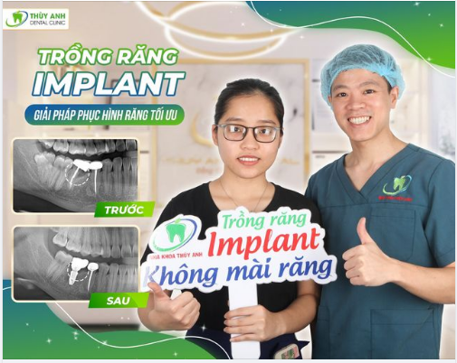 TRỒNG RĂNG IMPLANT 15 PHÚT ĐÃ XONG NHẸ NHÀNG - KHÔNG ĐAU