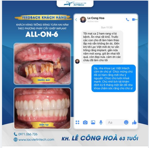 TRỒNG RĂNG IMPLANT ALL-ON-6 - GIẢI PHÁP KHÔI PHỤC RĂNG TOÀN HÀM ƯU VIỆT NHẤT HIỆN NAY