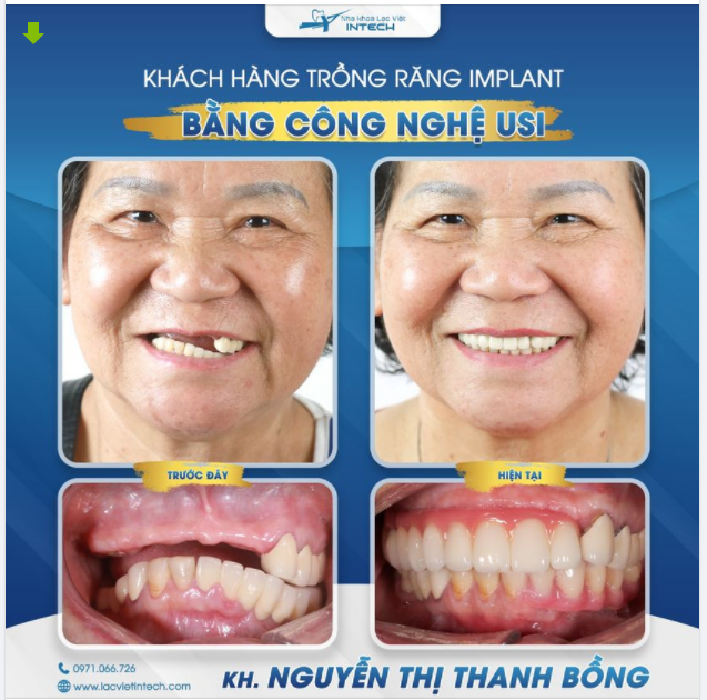 TRỒNG RĂNG IMPLANT CÔNG NGHỆ USI - GIỮ LẠI NỤ CƯỜI RẠNG RỠ QUA THÁNG NĂM